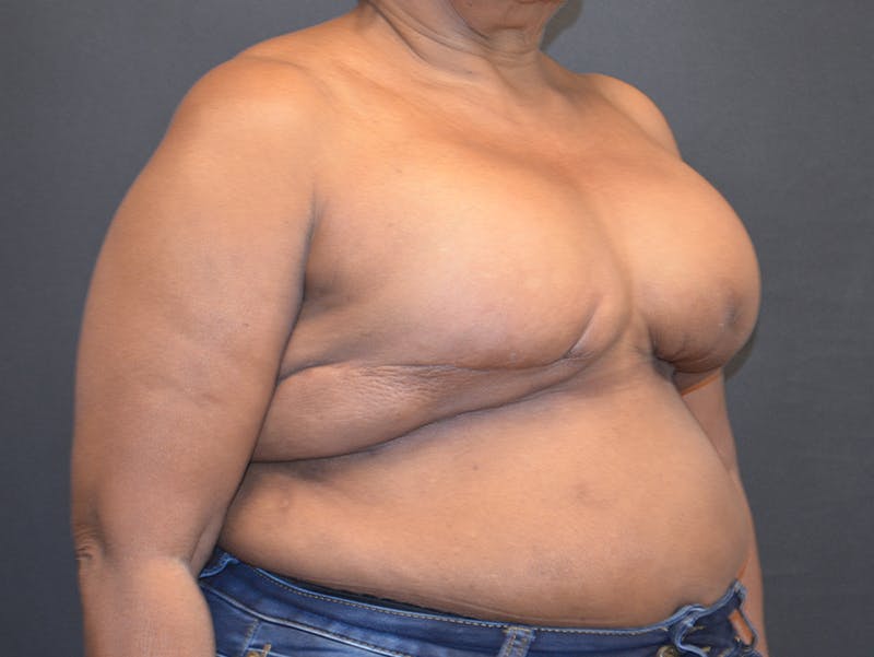 Breast Reconstruction Before & After Gallery - Patient 175234 - Image 4