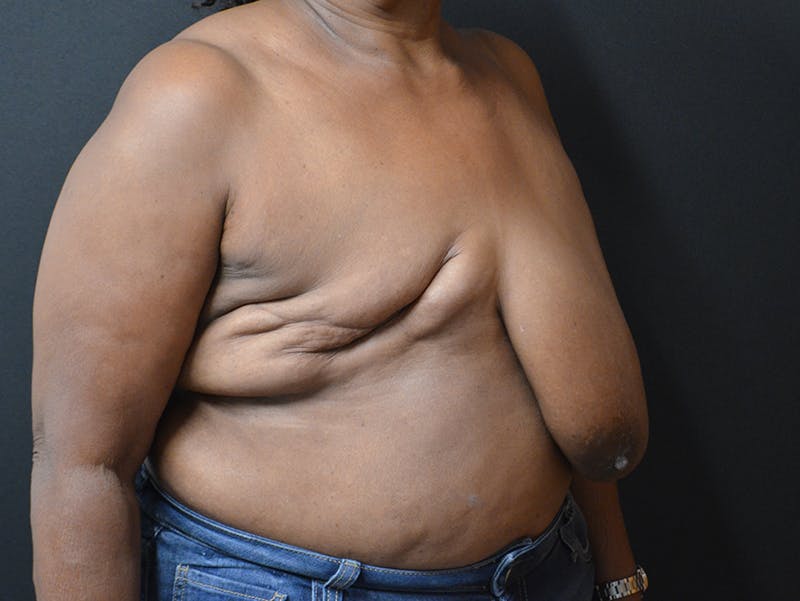 Breast Reconstruction Before & After Gallery - Patient 175234 - Image 3