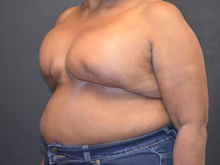 Breast Reconstruction Before & After Gallery - Patient 175234 - Image 6