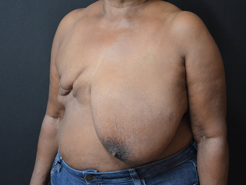 Breast Reconstruction Before & After Gallery - Patient 175234 - Image 5