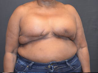 Breast Reconstruction Before & After Gallery - Patient 175234 - Image 2