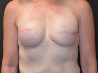 Breast Implant Reconstruction Before & After Gallery - Patient 105242 - Image 1