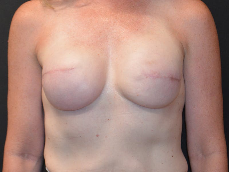 Breast Implant Reconstruction Before & After Gallery - Patient 105242 - Image 1